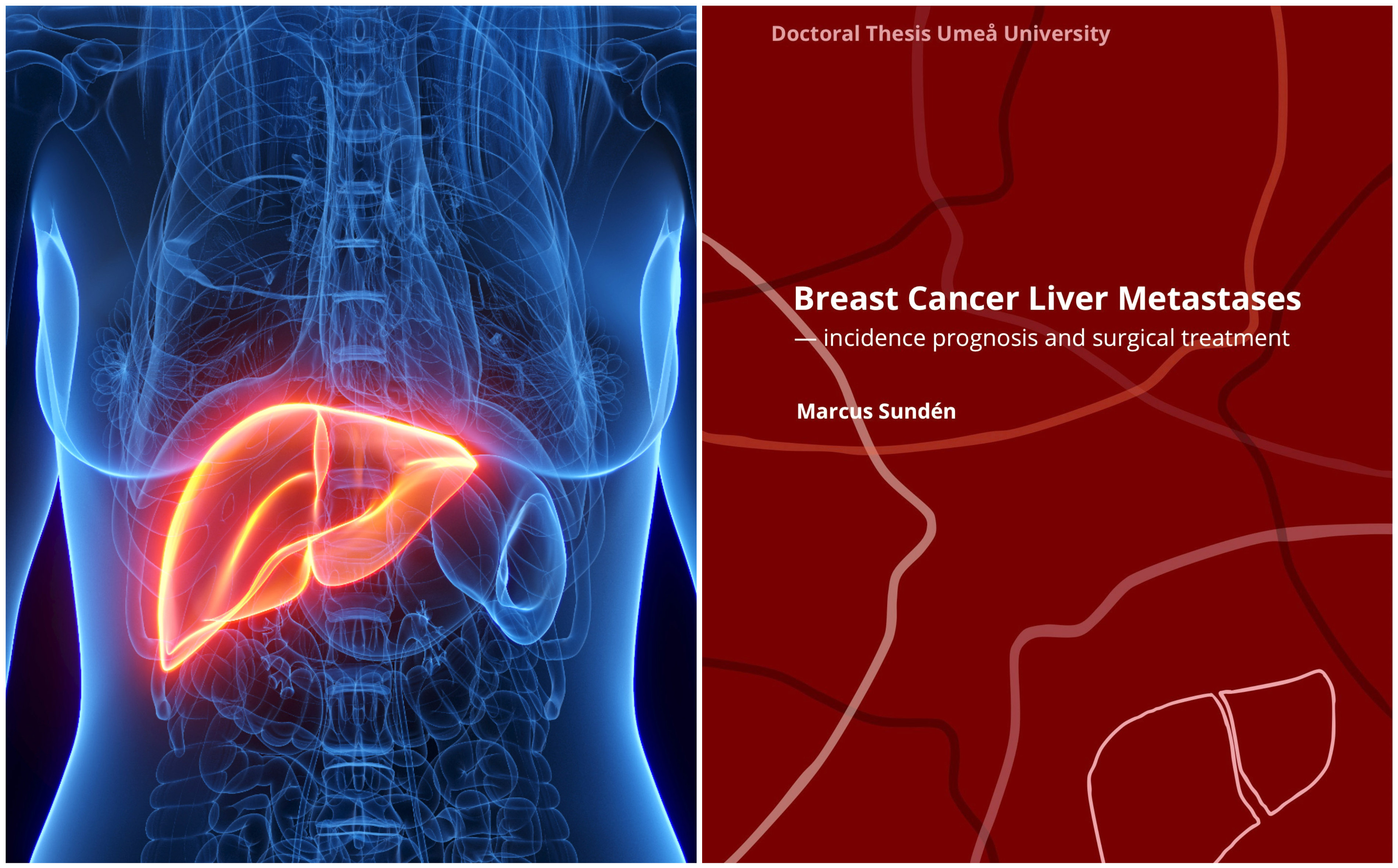 Breast cancer liver metastases